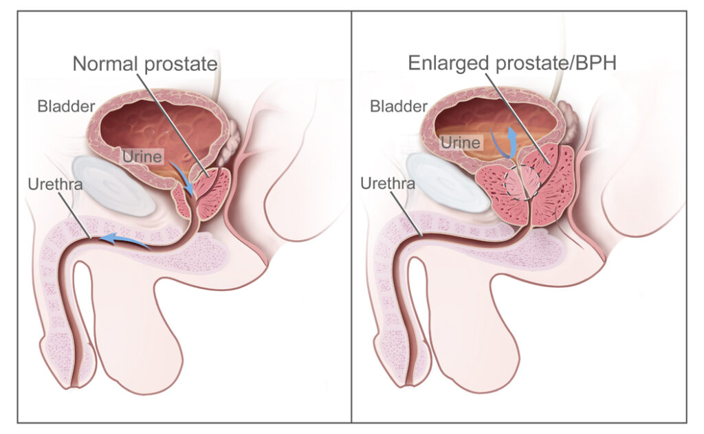 Benign Prostatic Hyperplasia Naples
